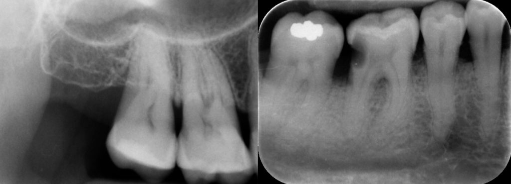 radiografías intrabucales o intraorales