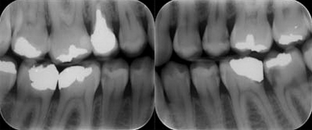 radiografías intrabucales o intraorales